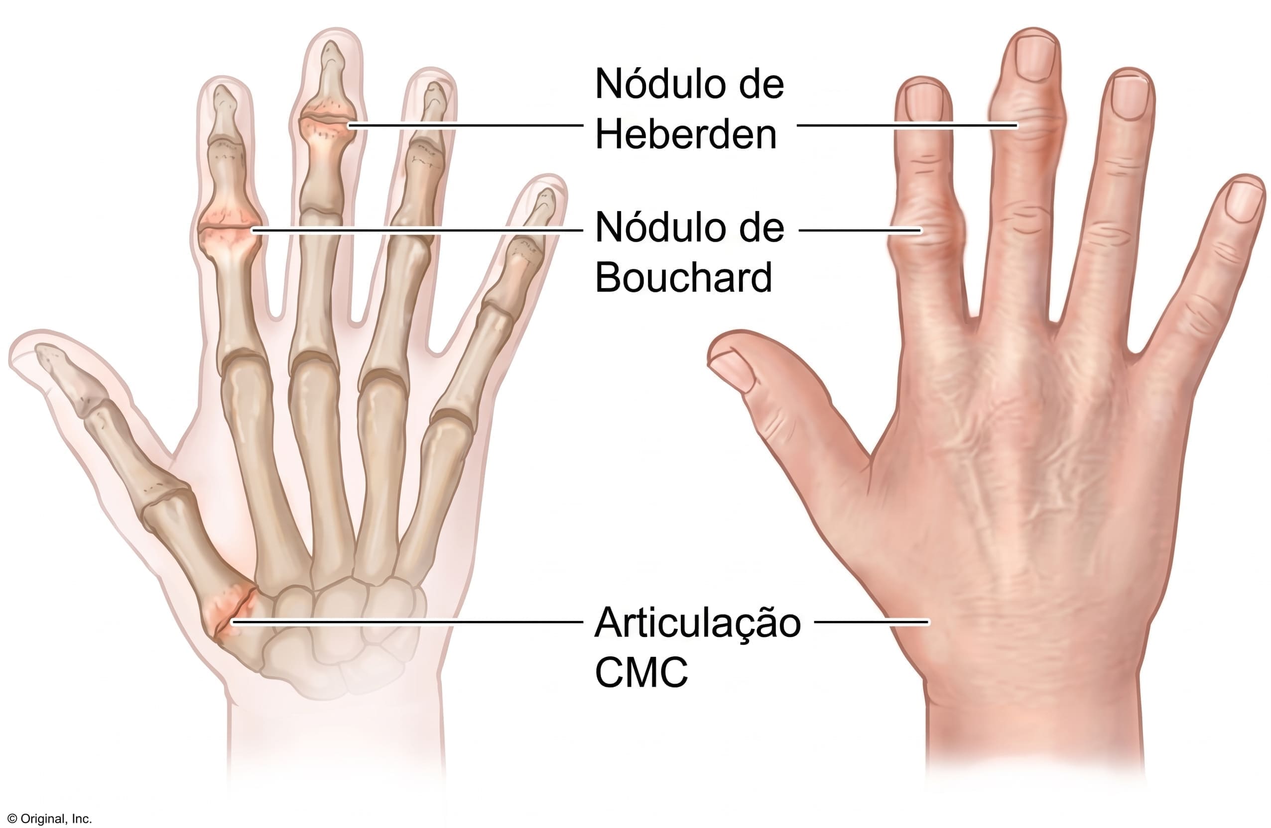 Nódulos de Heberden e Bouchard nas articulações dos dedos