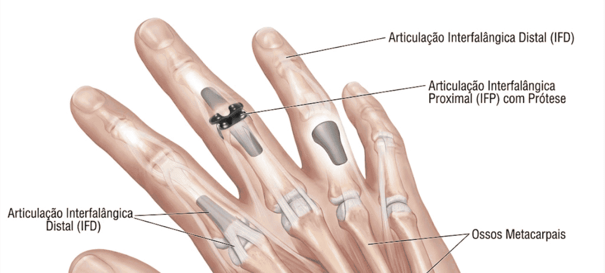 Prótese articular utilizada na artroplastia do dedo