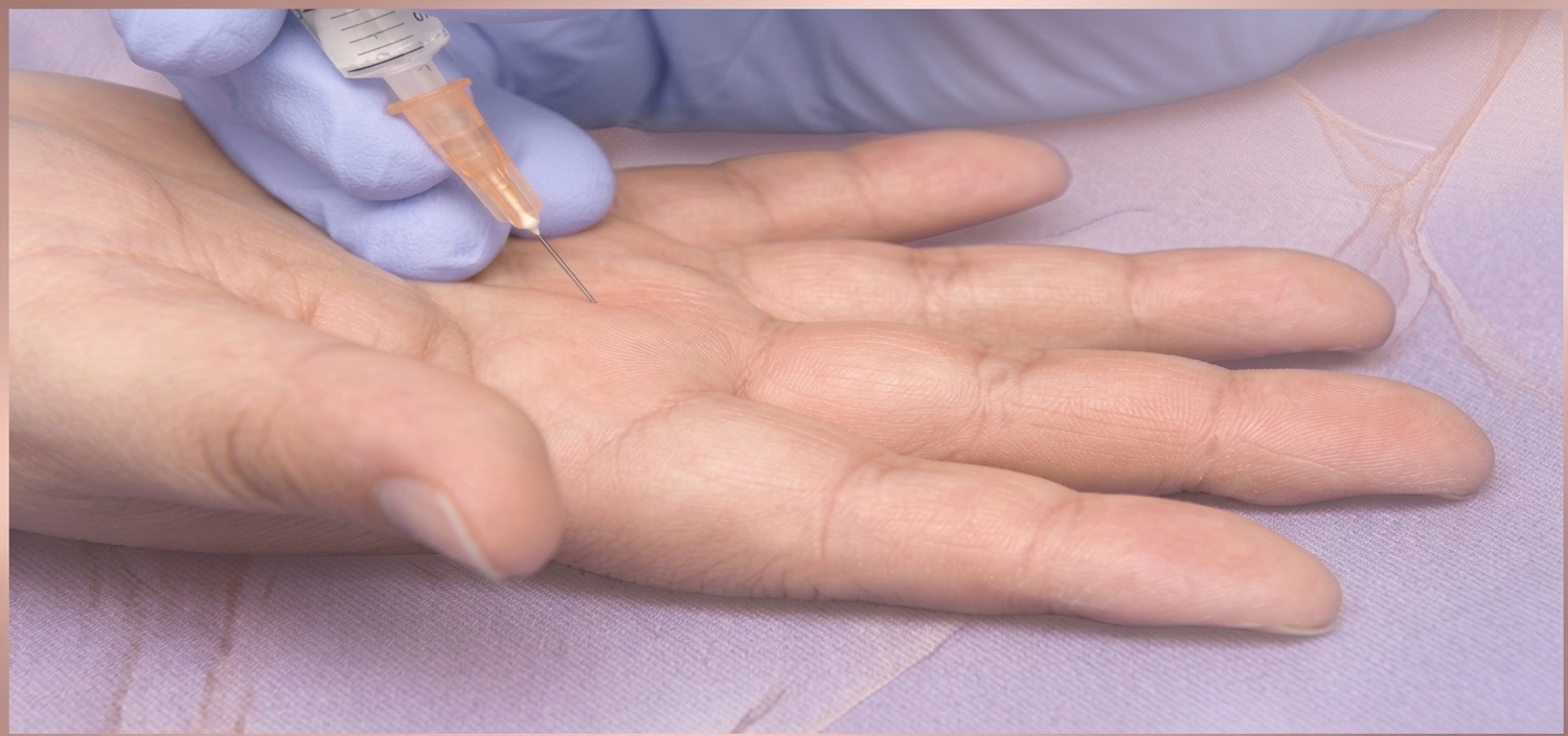 Infiltração de corticoide na palma da mão para tratamento do dedo em gatilho