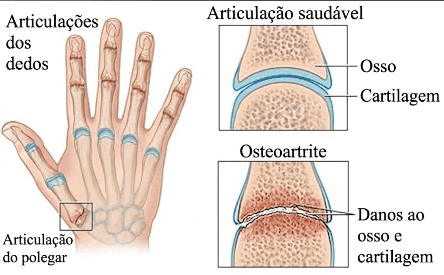 Anatomia da articulação do dedo mostrando o desgaste da cartilagem na artrose