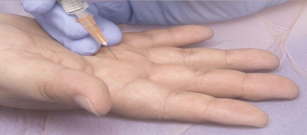 Aplicação de infiltração de corticoide na palma da mão para tratamento de dedo em gatilho