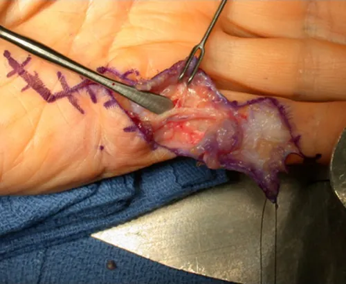 Cirurgia da mão para fasciectomia no tratamento da doença de Dupuytren