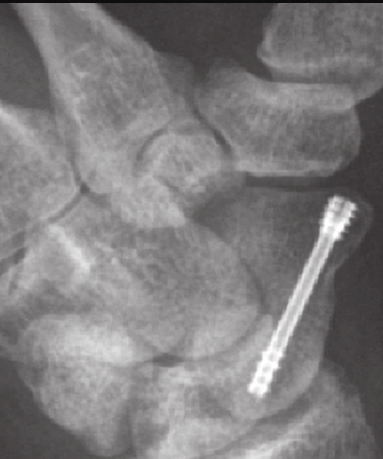 Radiografia do punho mostrando parafuso de compressão fixando a fratura do escafoide
