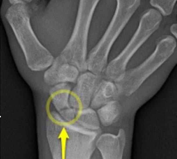 Radiografia do punho com a fratura do escafoide assinalada